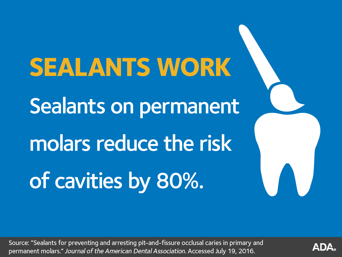 fissure sealants on teeth