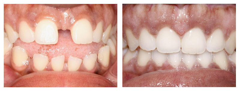 Invisalign treatment-before and after