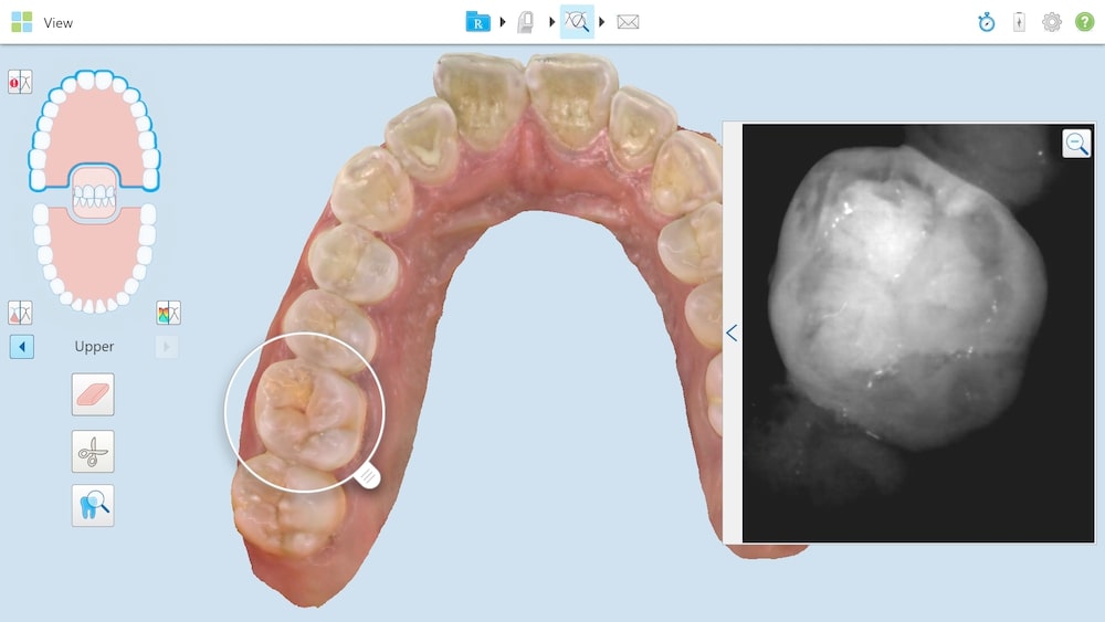 iTero digital scan teeth